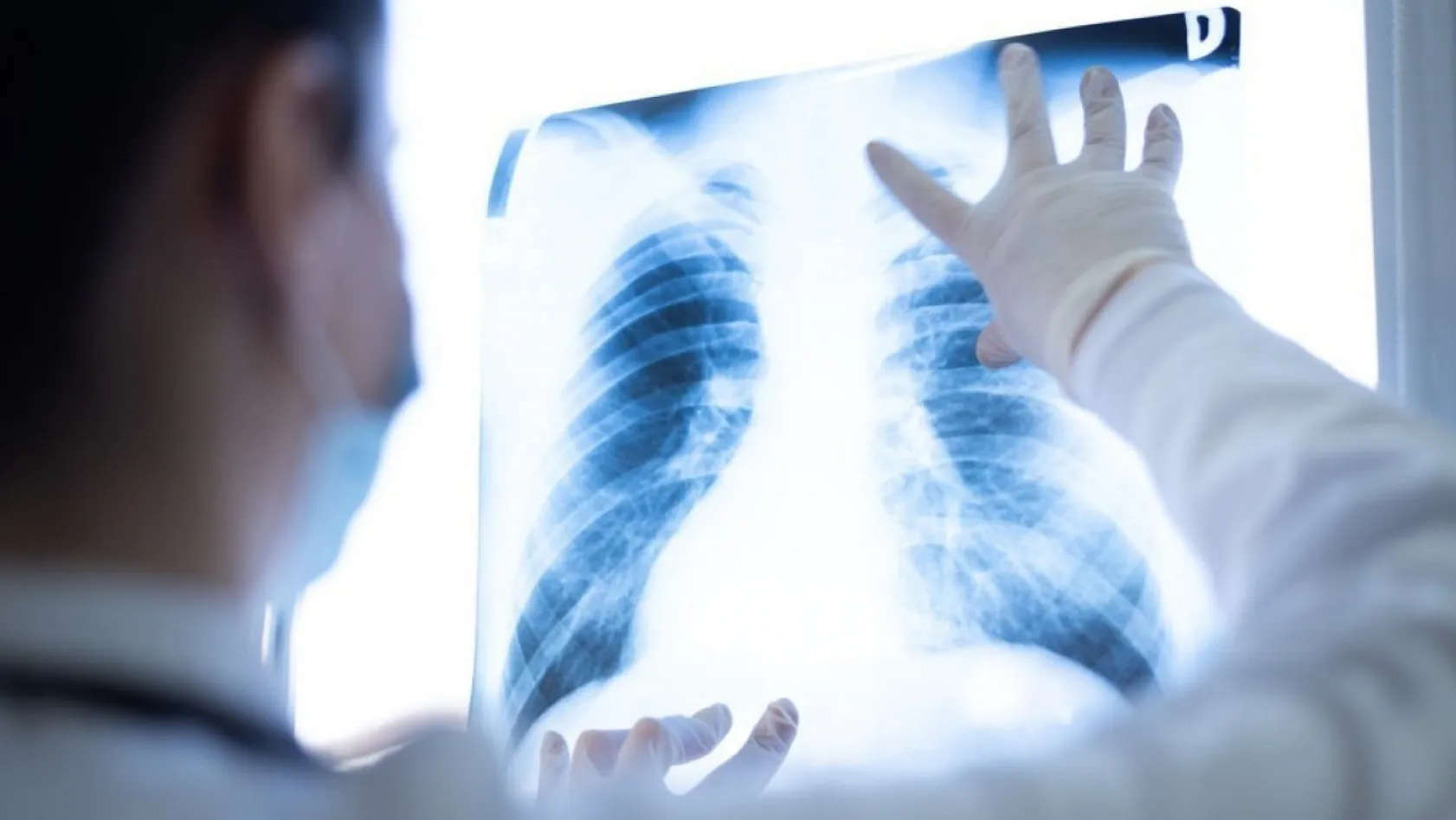'Ciğerlerde kalan Covid-19 nodülleri akciğer kanseri başlangıcı olabilir'
