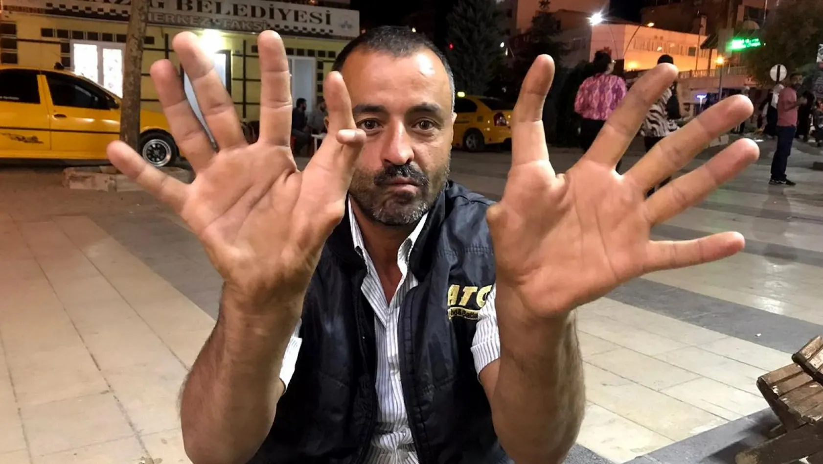 11 parmaklı adam görenleri hayrete düşürüyor