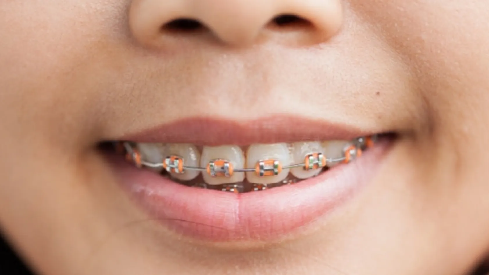 Diş teli takmadan ortodonti tedavisi mümkün