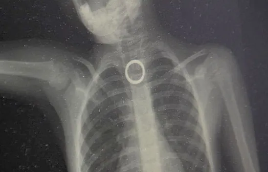 3 yaşındaki çocuk ölümden döndü