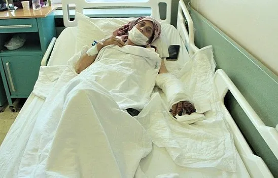 Kopan parmakları 6 saatlik operasyonla dikildi