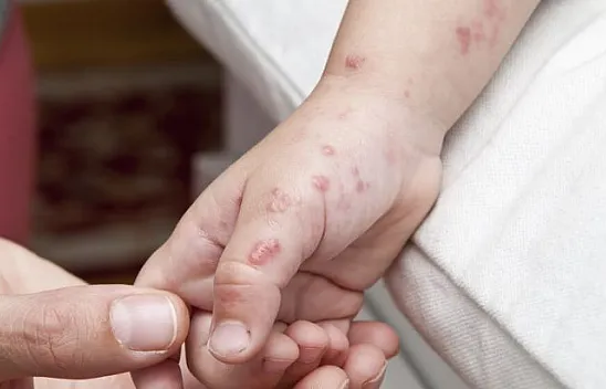 Maymun Çiçeği Türkiye'de görüldü!