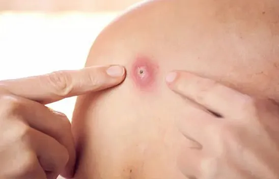 Maymun çiçeği virüsü alarmı!