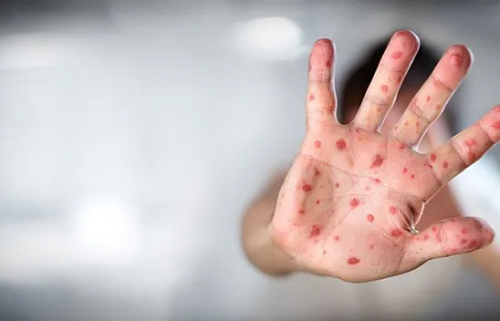 Virüs 4 ülkeye daha sıçradı!