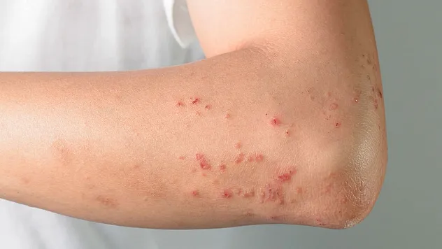 'Behçet hastalığı görme kaybına neden olabiliyor'