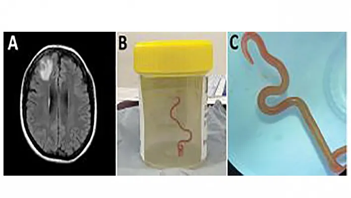 Dünyada ilk! Beyninden canlı solucan çıkarıldı