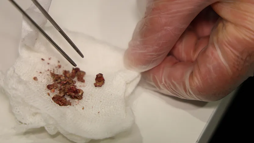 Elazığ'da estetik ameliyatta şaşırtan olay!